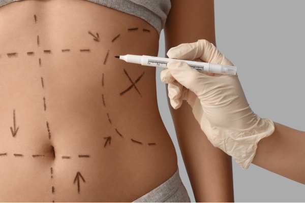 abdominoplastia